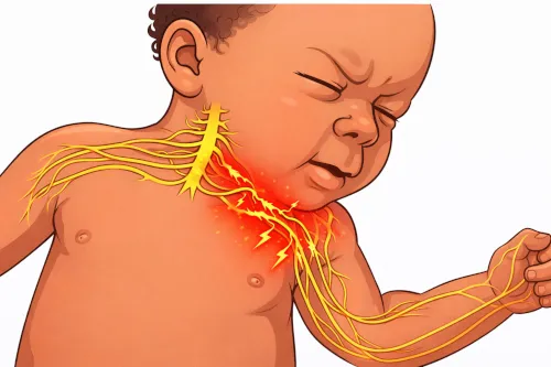 Obstetric Brachial Plexus Lesion